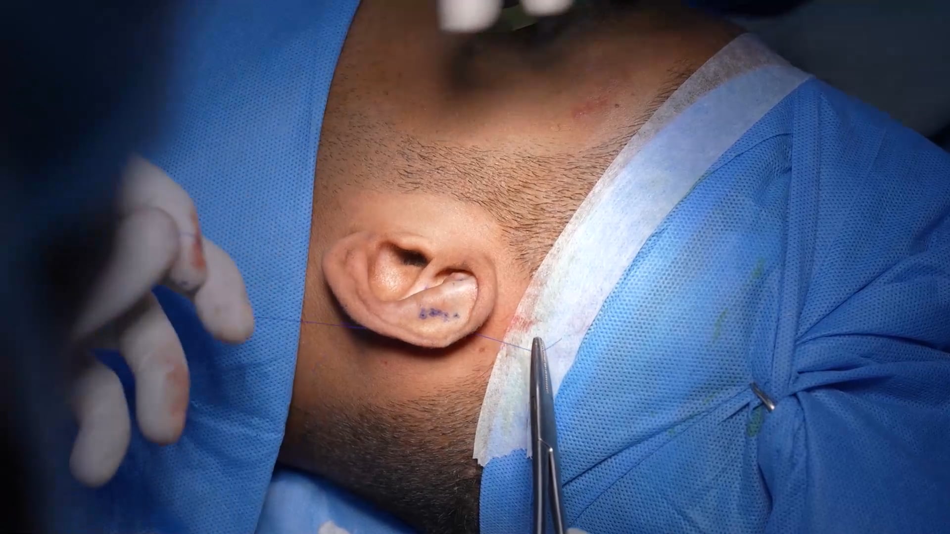 Optoplasty Surgery